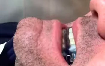 Aparelho de avanço mandibular, customizado sem grampos em acetato de 2,5 mm