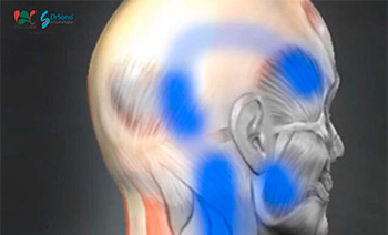 Dores cervicais (do pescoço) são muito comuns em pacientes com DTM e Distúrbios do Sono (apneia principalmente)