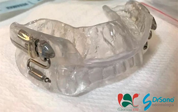 O Bruxismo do Sono (BS) pode ser controlado com eficiência com os aparelhos de avanço mandibular