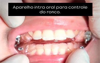 O ano começou em ritmo acelerado, e aqui está mais um caso com a instalação de aparelho intraoral para o controle do ronco
