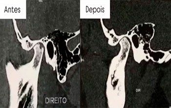 Osteoartrite da ATM encontra solução com os agregados plaquetários
