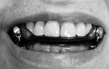 O Bruxismo do Sono (BS) pode ser controlado com eficiência com os aparelhos de avanço mandibular